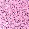 28B1 Pituitary Adenoma, Crooke's Cell Type (Case 28) Retic 20X 2
