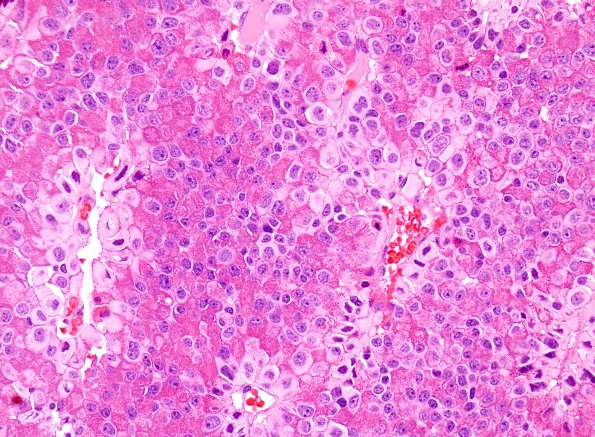 3A1 PR CH (Case 3) H&E 6