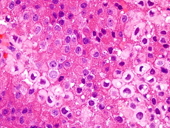 3A2 PR CH (Case 3) H&E 1