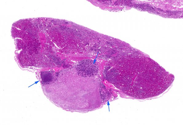 6A1 PA, Nl Basophil (Case 6) H&E WM