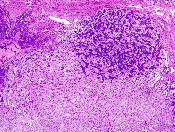 6A2 PA, Nl Basophil (Case 6) H&E 3