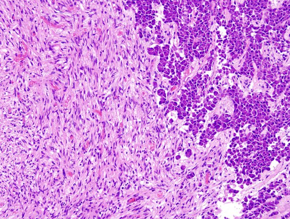 6A3 PA, Nl Basophil (Case 6) H&E 5