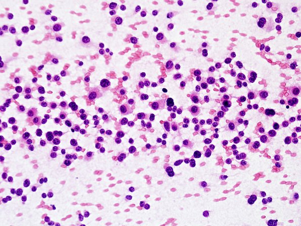 9B1 PA CR (Case 9)smear H&E 1.jpg