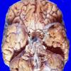 2A1 Pituitary adenoma (Case 2) 1