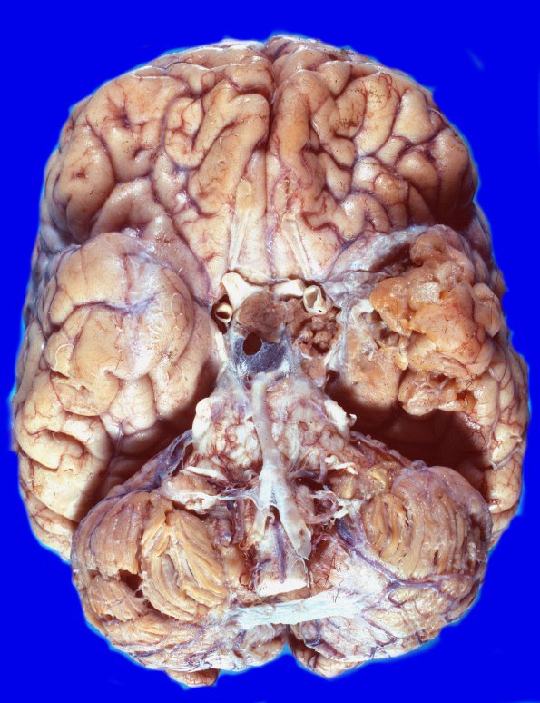 2A1 Pituitary adenoma (Case 2) 1