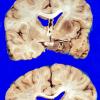 2A4 Pituitary Adenoma (Case 2) 3