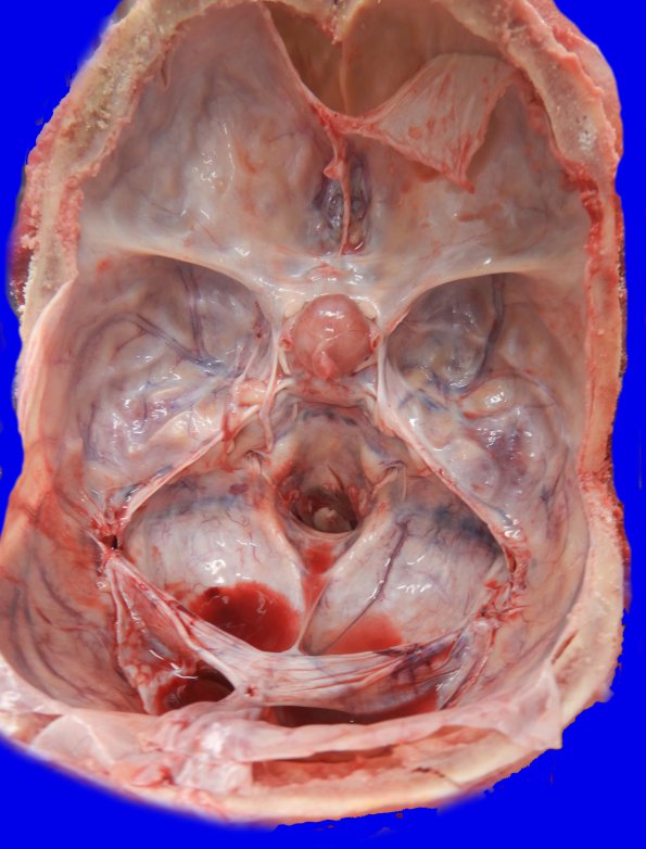 3A1 Pituitary Adenoma (Case 3) _3