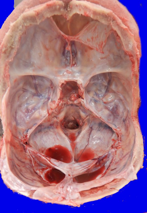 3A3 Pituitary Adenoma (Case 3) _4