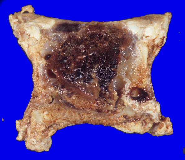 7A2 Pituitary Adenoma resection, SP Cardiac Arrest (Case 7) 6