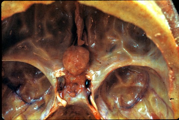 8A Pituitary Adenoma (Case 8) gross 1