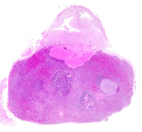 1A1 Multiple microadenomas (Case 1) H&E WM