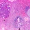 1A2 Multiple microadenomas (Case 1) 2X - labeled copy