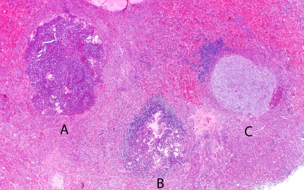 1A2 Multiple microadenomas (Case 1) 2X - labeled copy