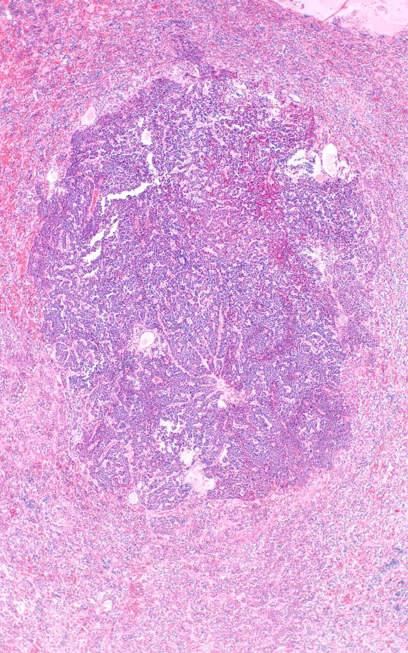 1A3 Multiple microadenomas (Case 1) 2X Area A 4X A