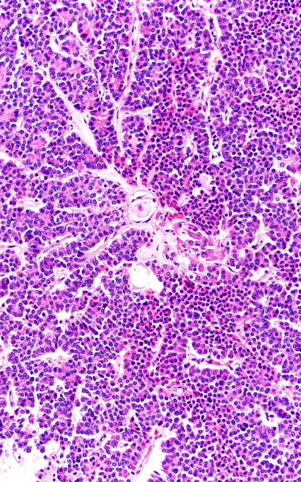 1A4 Multiple microadenomas (Case 1) 2X Area A 20X