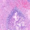 1A5 Multiple microadenomas (Case 1) 2X Area B 4X 2 A