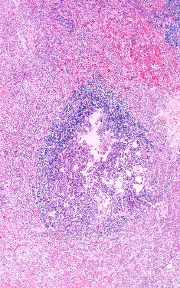 1A5 Multiple microadenomas (Case 1) 2X Area B 4X 2 A