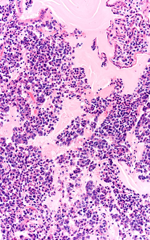 1A6 Multiple microadenomas (Case 1) Area B 20X A