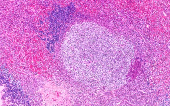 1A7 Multiple microadenomas (Case 1) Area C 4X