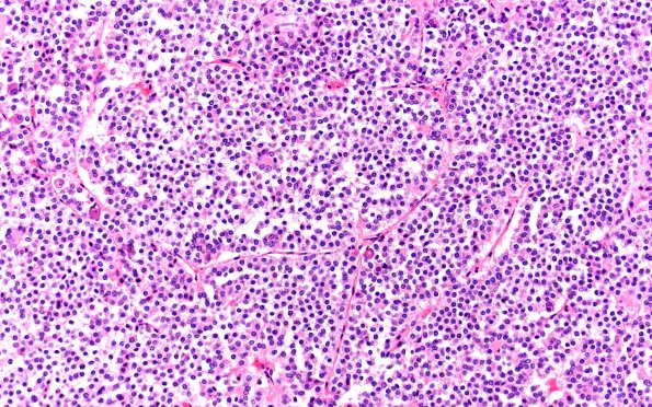 1A8 Multiple microadenomas (Case 1) 2X Area C 20X