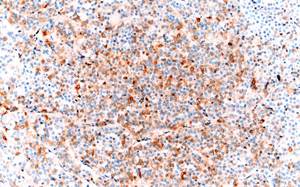 1C7 Multiple microadenomas (Case 1) 20X FSH Area C 2