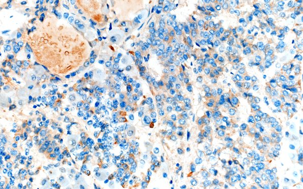 1D2 Multiple Microadenomas (Case 1) Prolactin Area B 40X