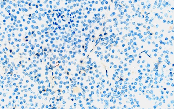 1D3 Multiple Microadenomas (Case 1) Prolactin Area C 40X