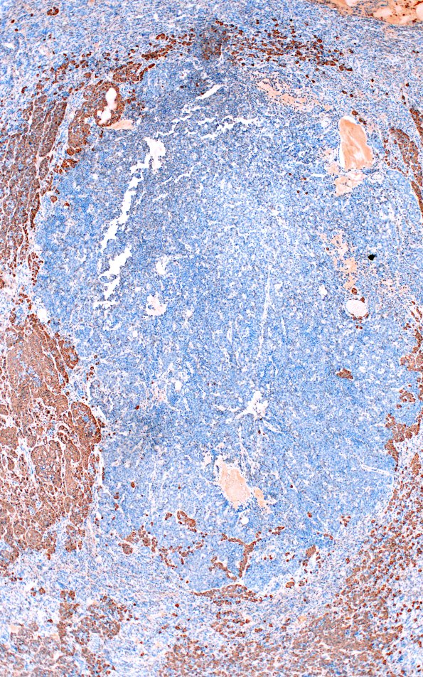 1E2 Multiple microadenomas (Case 1) 4X ACTH Area A