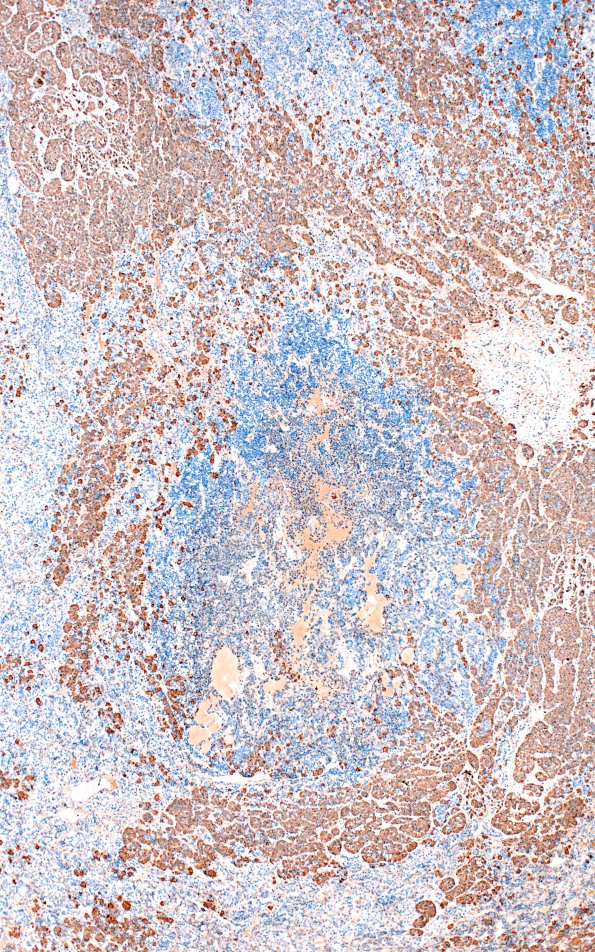 1E3 Multiple microadenomas (Case 1) 4X ACTH Area B