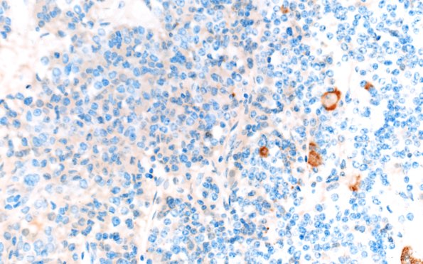 1E4 Multiple microadenomas (Case 1) 40X ACTH Area B