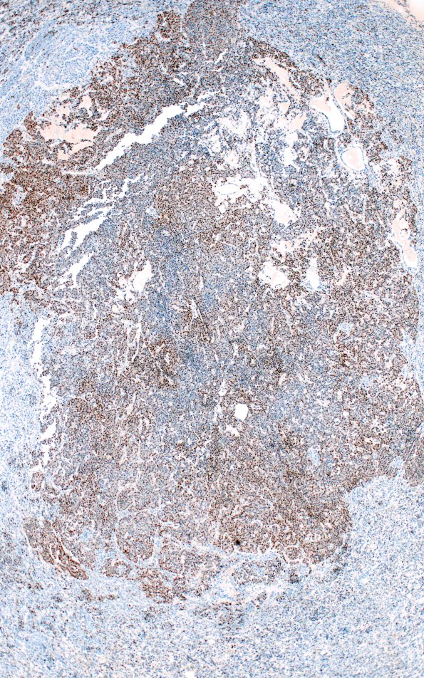 1H2 Multiple microadenomas (Case 1) PIT-1 4X Area A A