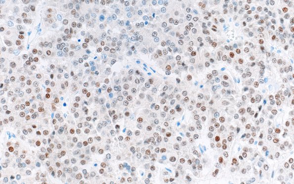 1H3 Multiple microadenomas (Case 1) PIT-1 40X Area A