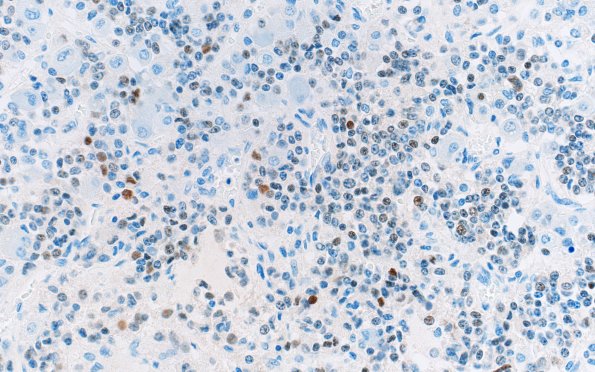 1H5 Multiple microadenomas (Case 1) PIT-1 40X Area B