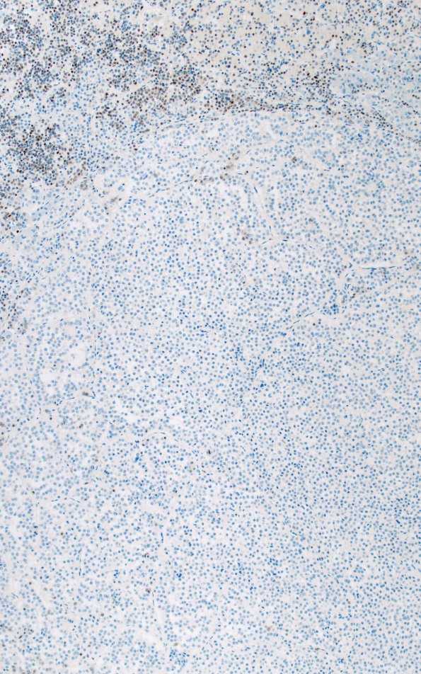 1H7 Multiple microadenomas (Case 1) PIT-1 10X Area C