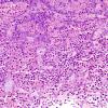 10A1 Pituitary Adenoma & Apoplexy (Case 10) H&E 4