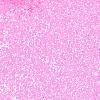 1A2 Pituitary adenoma, apoplexy, granulation tissue (Case 1) H&E 7