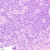 1A4 Pituitary adenoma, apoplexy, granulation tissue (Case 1) H&E 10X 1