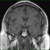 2A Pituitary Adenoma, apoplexy (Case 2) MRI T1 1 - Copy