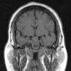 3A1 Pituitary adenoma, apoplexy (Case 3) T1noC 2