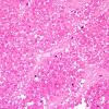 3B2 Pituitary adenoma, apoplexy (Case 3) dead tumor H&E 2.jpg