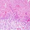 3B3 Pituitary adenoma, apoplexy (S14-37255) Interface rxn & dead tumor H&E.jpg