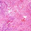 7A3 Pituitary Adenoma & apoplexy (Case 7) H&E 2