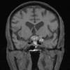 9A1 Pituitary adenoma, apoplexy (Case 9) T1noC 4A - Copy