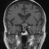 9A1 Pituitary adenoma, apoplexy (Case 9) T1noC A - Copy