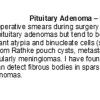 0A Pituitary Adenoma - Intraoperative Smear