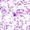 7 Pituitary adenoma (Case 7) H&E smear