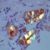 5C4 PA, PML, Amyloid (Case 5) CR 7P 2.jpg