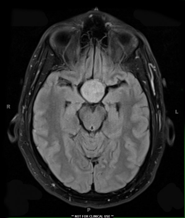 1A1 Pituitary Adenoma (Case 1) TIRM 1 - Copy