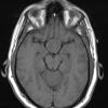 1A2 Pituitary Adenoma (Case 1) T1 2 - Copy