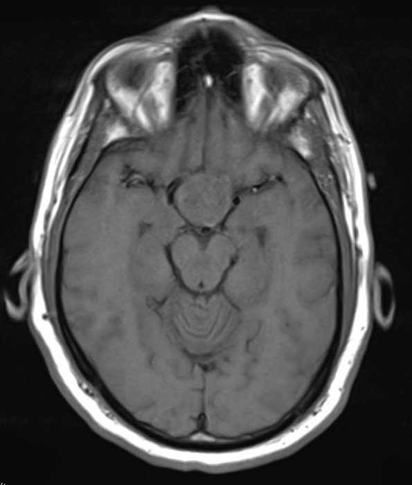 1A2 Pituitary Adenoma (Case 1) T1 2 - Copy